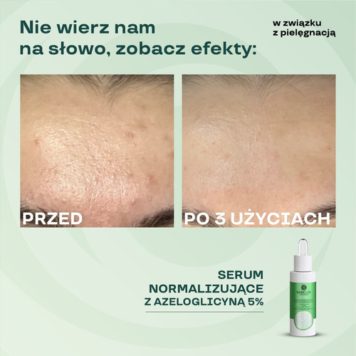 BasicLab Normalizing Anti-Blackhead Serum with 5% Azeloglycine and 1% BHA for Problematic Skin 30ml