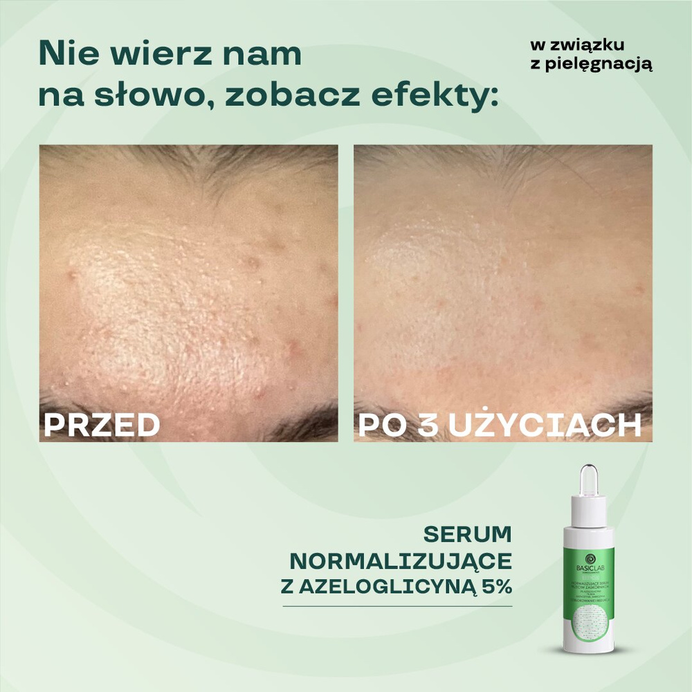 BasicLab Normalizujące Serum Przeciw Zaskórnikom z 5% Azeloglicyny i 1% BHA dla Skóry Problematycznej 30ml